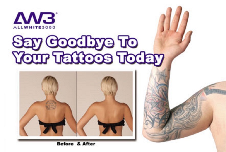 Tatoo Removal